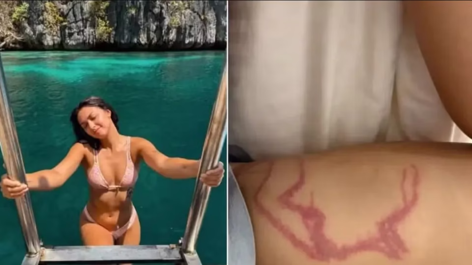 Influencer É Picada Por Espécie De Água-Viva &Quot;Mais Venenosa&Quot; Do Mundo