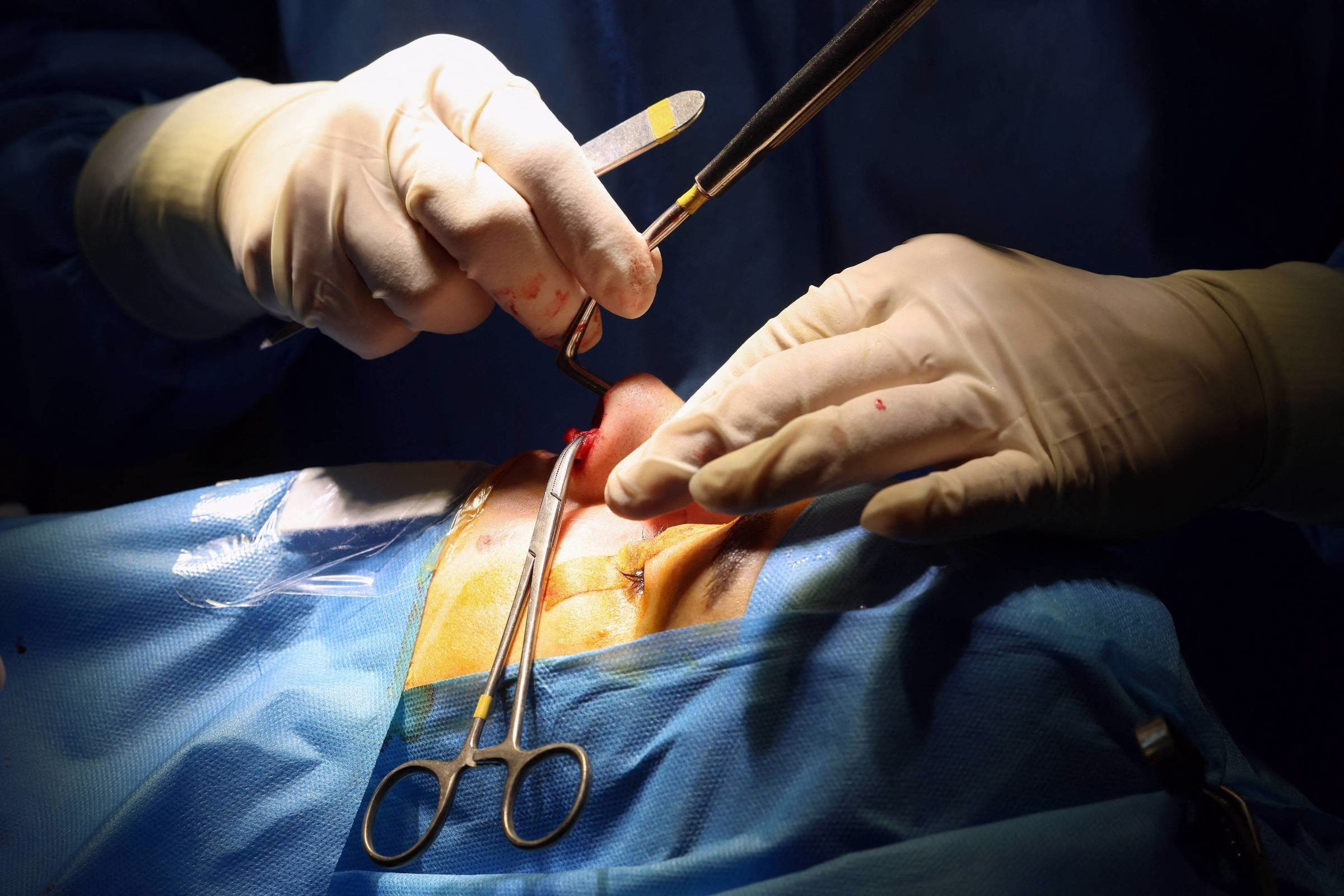 Iranianas Fazem Cirurgias Estéticas Para Ter Oportunidades - 09/04/2025 - Equilíbrio