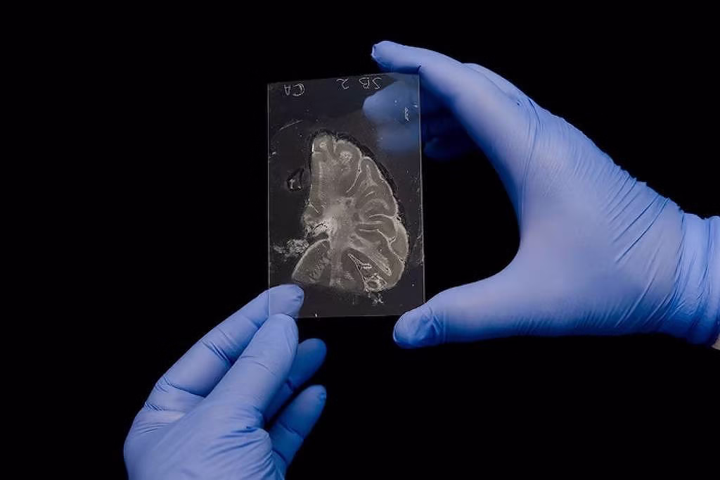 Lítio Pode Reverter Alzheimer, Revela Estudo De Harvard - 06/08/2025 - Equilíbrio E Saúde