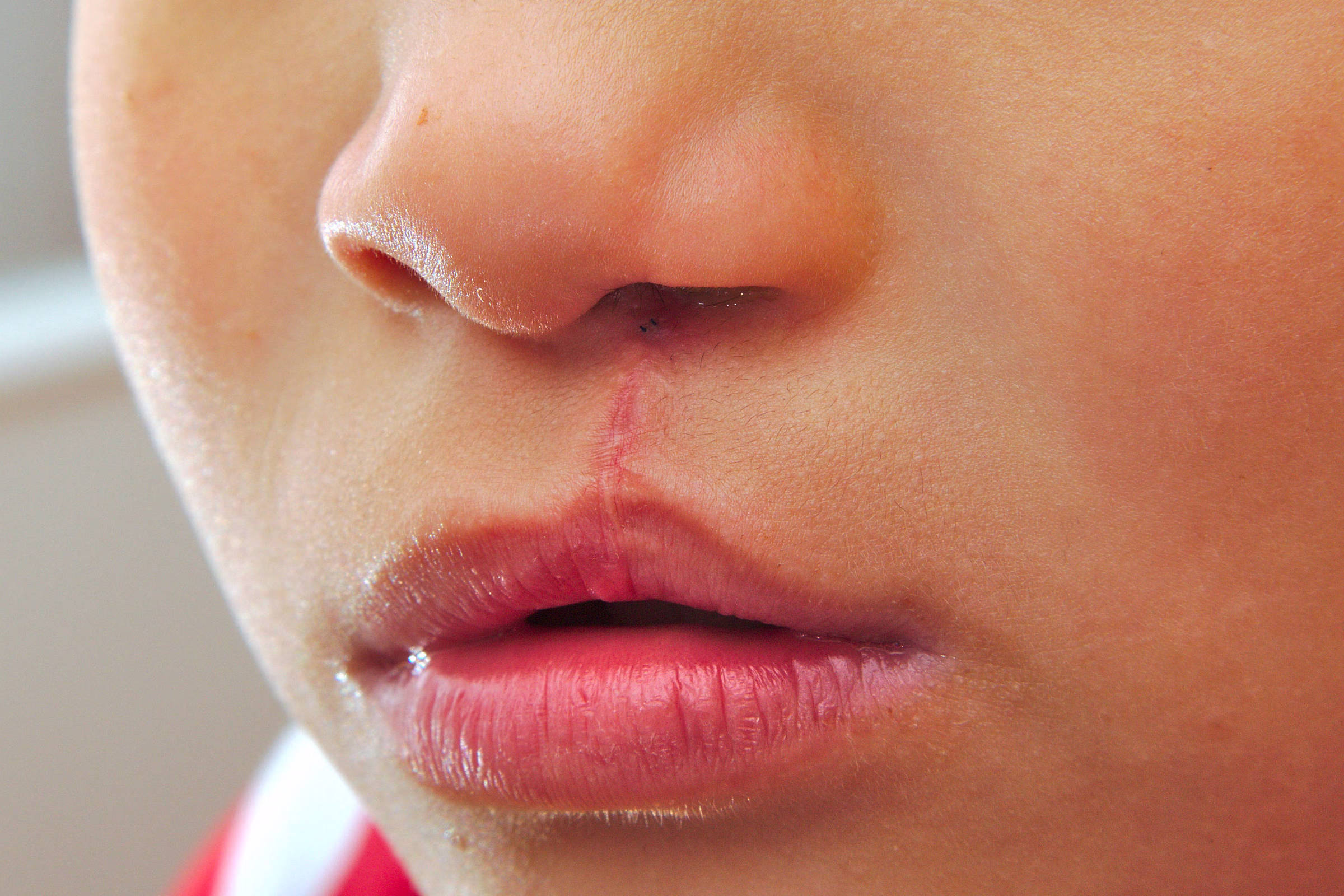 Lula Sanciona Lei Que Obriga Cirurgia De Lábio Leporino No Sus - 07/05/2025 - Equilíbrio E Saúde