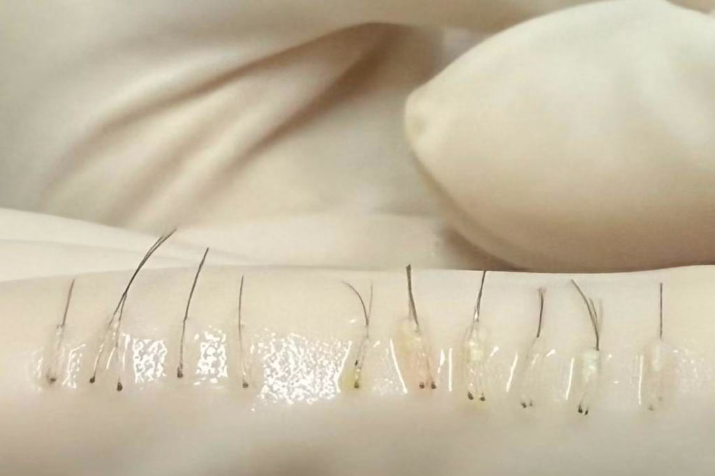 Entenda Como Funciona Transplante De Sobrancelhas - 04/06/2025 - Equilíbrio