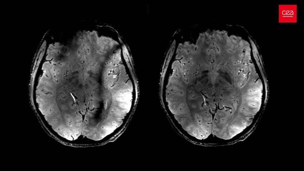 Inteligência artificial prevê envelhecimento cerebral - 30/07/2025 - Equilíbrio e Saúde