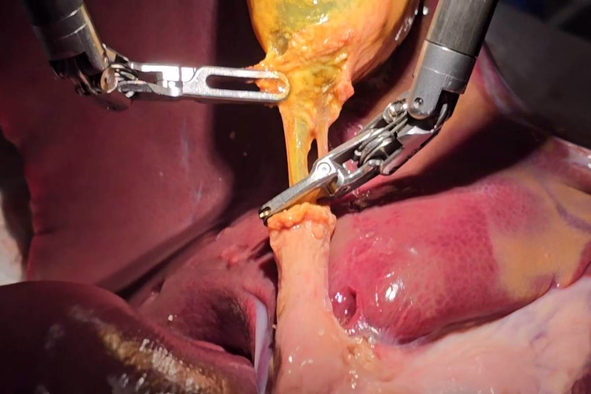 Robô Com Ia Alcança Autonomia Em Cirurgia - 11/07/2025 - Equilíbrio E Saúde